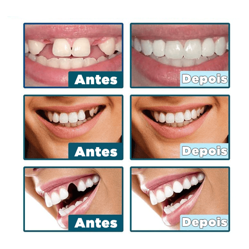 SmileFit® - Facetas Dentárias Naturais Removíveis