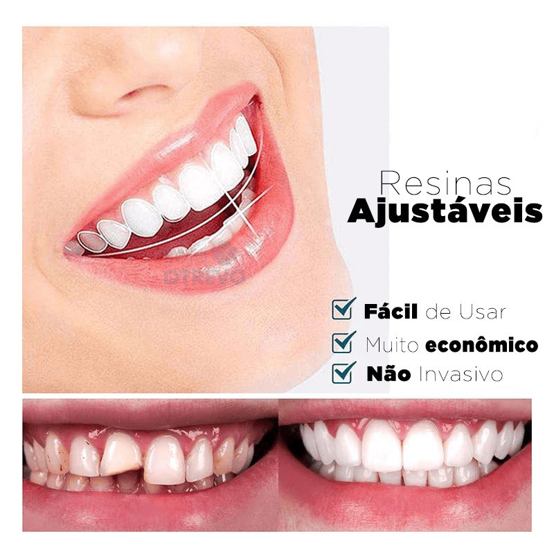 SmileFit® - Facetas Dentárias Naturais Removíveis